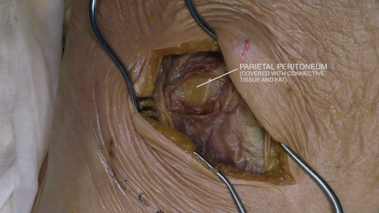 Label: Parietal peritoneum (covered with connective tissue and fat)