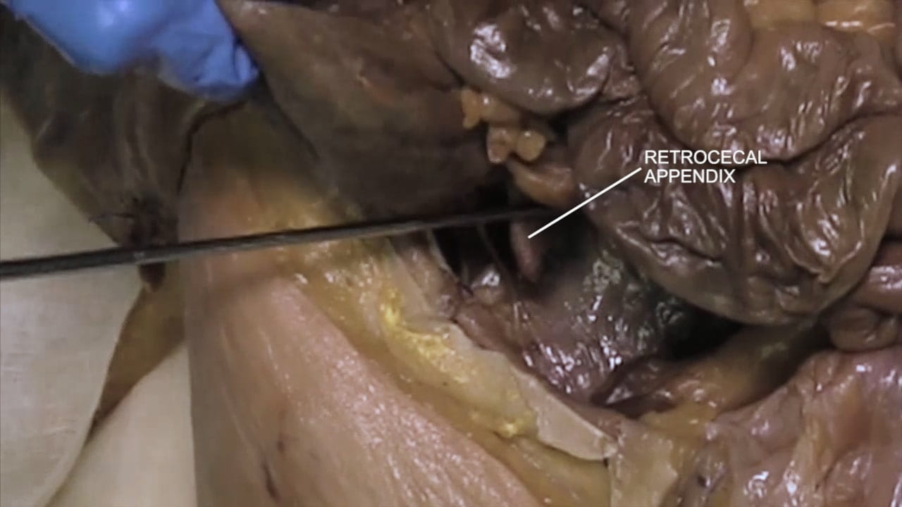 Label: Retrocecal appendix