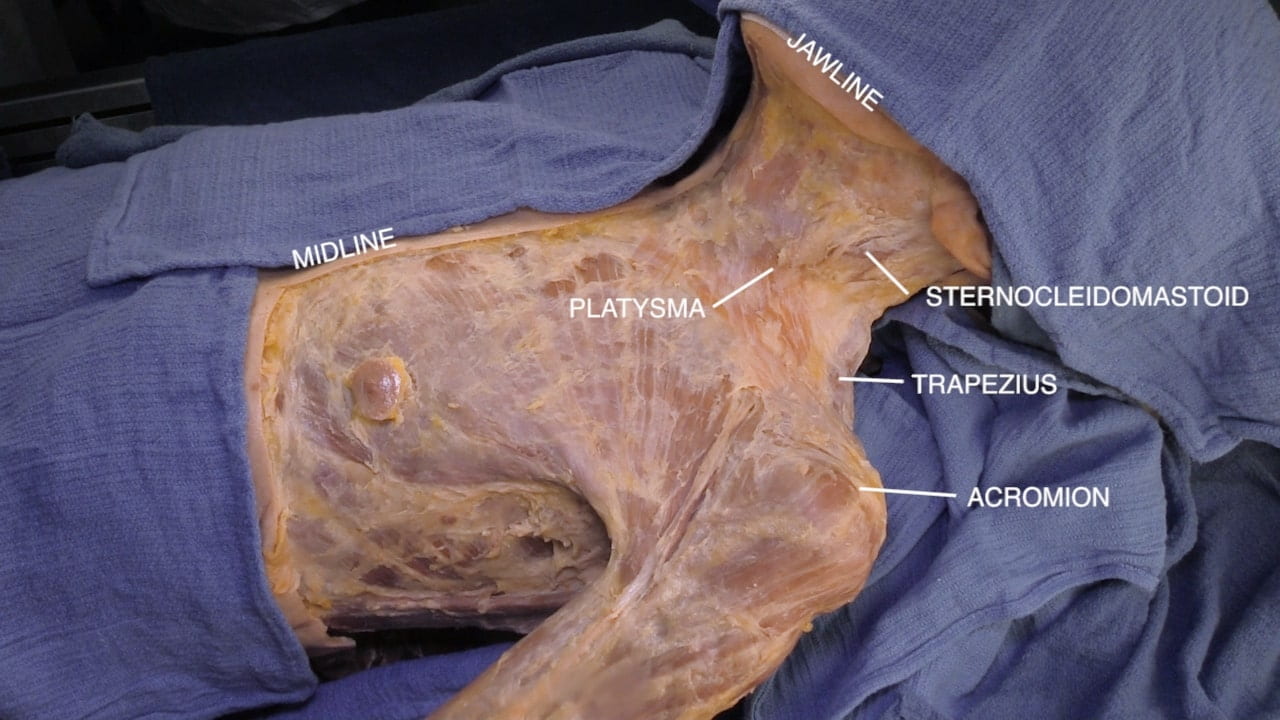 Labels (top to bottom): Jawline, midline, sternocleidomastoid, platysma, trapezius, acromion