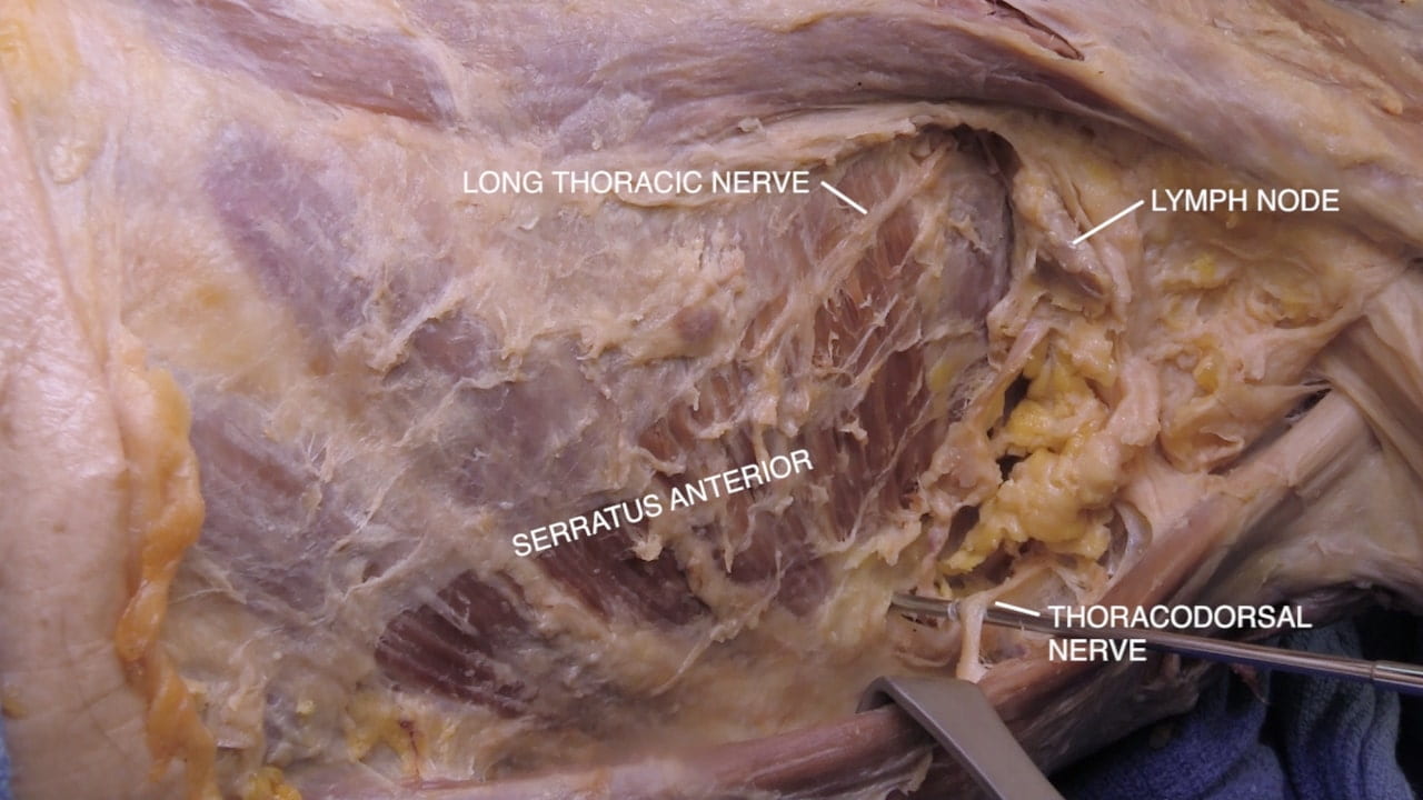 Labels (top to bottom): Long thoracic nerve, lymph node, serratus anterior, thoracodorsal nerve