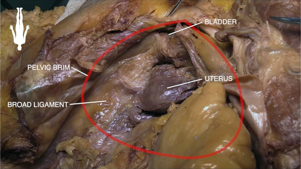 Labels (left to right): Broad ligament, pelvic brim, bladder, uterus