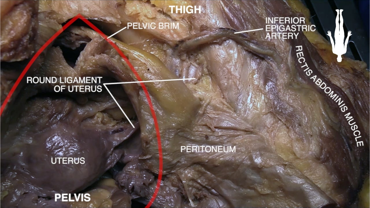 Labels (top to bottom): Thigh, inferior epigastric artery, pelvic brim, rectis abdominis muscle, round ligament of uterus, peritoneum, uterus, pelvis