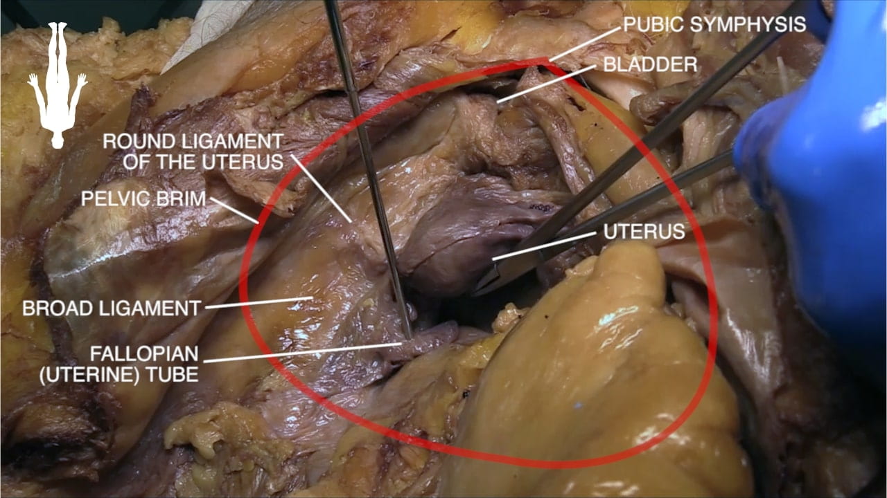 Labels (top to bottom): Pubic symphysis, bladder, round ligament of the uterus, pelvic brim, uterus, broad ligament, fallopian (uterine) tube