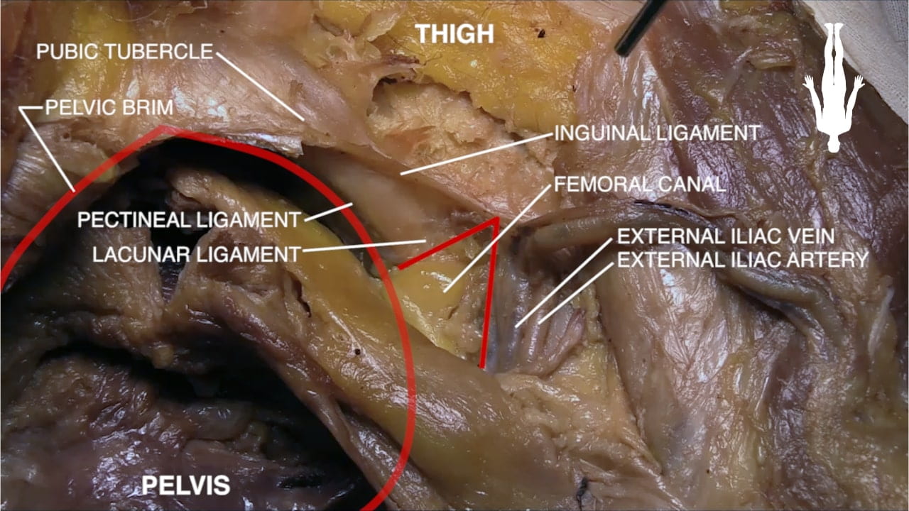 Labels (top to bottom): thigh, pubic tubercle, pelvic brim, inguinal ligament, femoral canal, pectineal ligament, external iliac vein, external iliac artery, lacunar ligament, pelvis