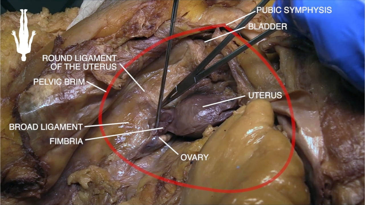 Labels (top to bottom): Pubic symphysis, bladder, round ligament of the uterus, pelvic brim, uterus, broad ligament, fimbria, ovary