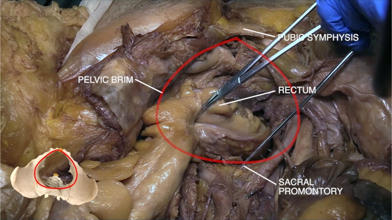 Labels (left to right): pelvic brim, pubic symphysis, rectum, sacral promontory