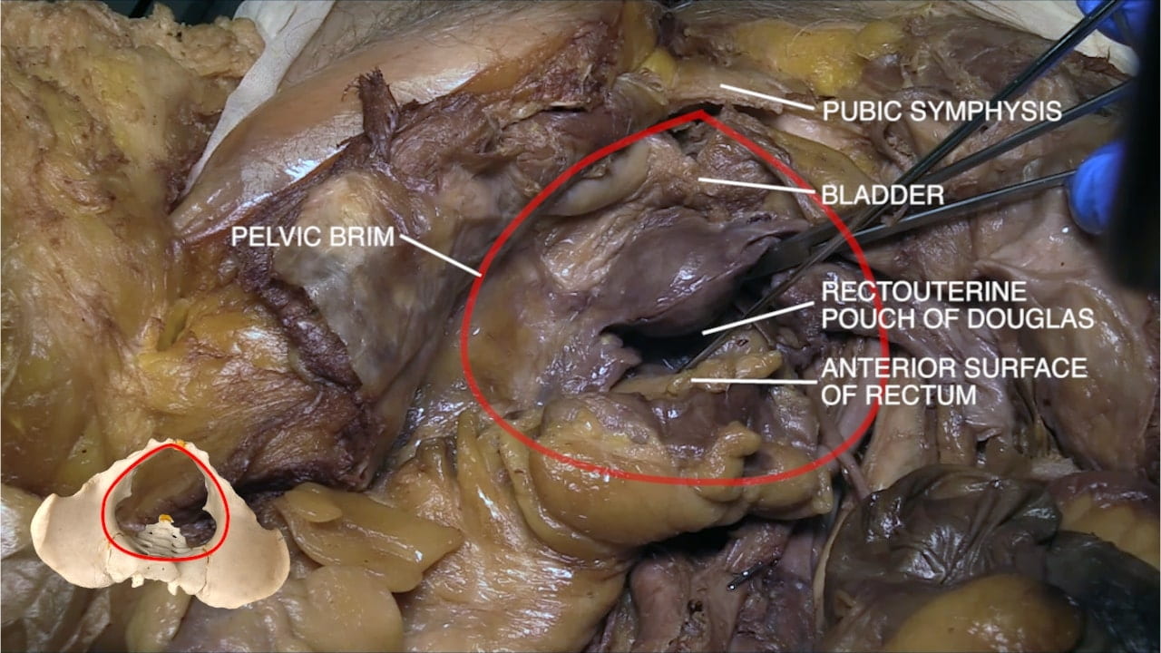 Labels (top to bottom): Pubic symphysis, bladder, pelvic brim, rectouterine pouch of Douglas, anterior surface of rectum