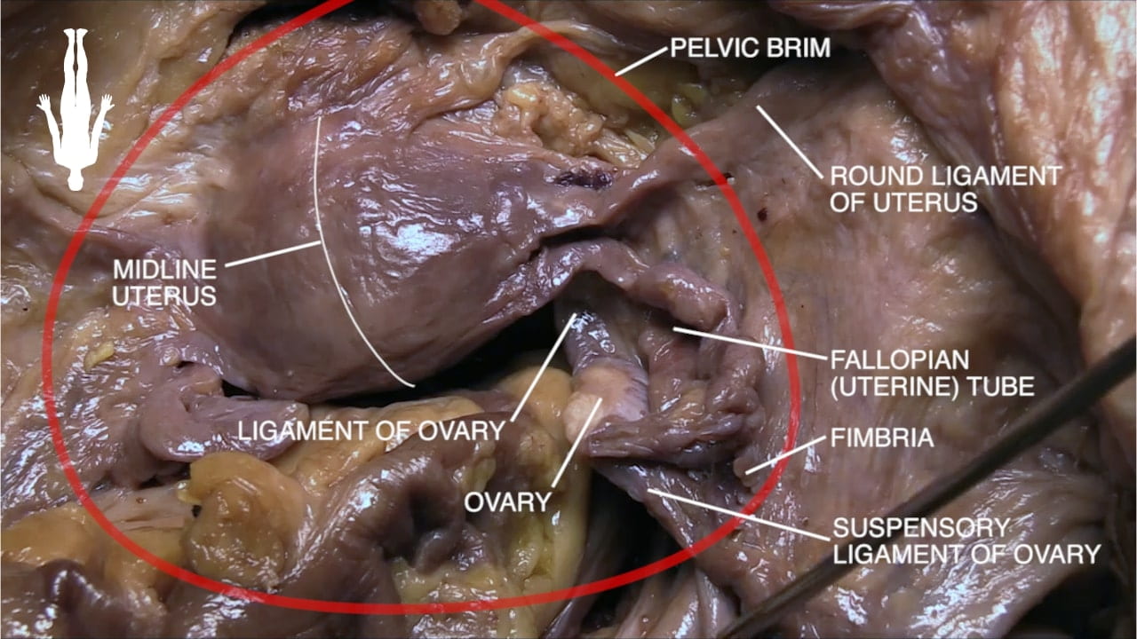 Labels (left to right): Midline uterus, ligament of ovary, ovary, pelvic brim, round ligament of uterus, fallopian (uterine) tube, fimbria, suspensory ligament of ovary