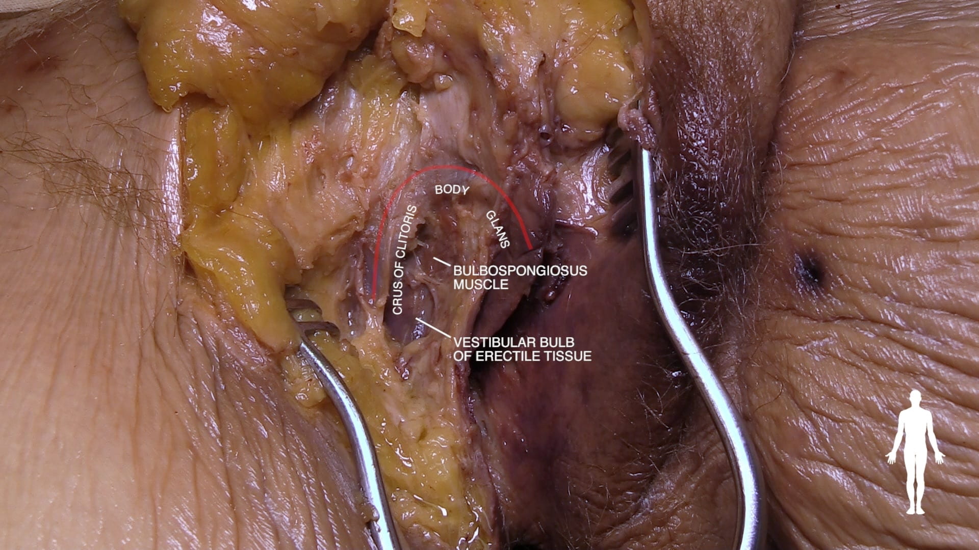 Labels (left to right): Crus of clitoris, body, glans, bulbospongiosus muscle, vestibular bulb of erectile tissue