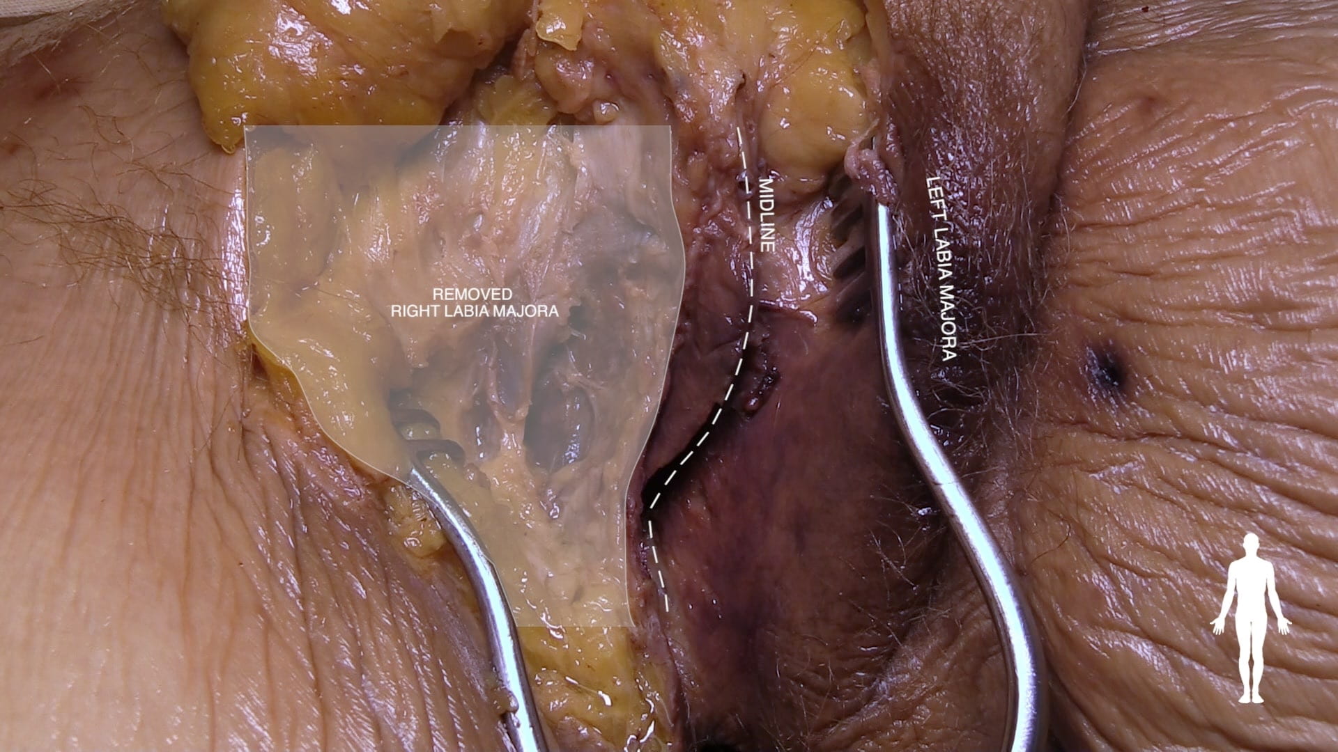 Labels (left to right): Removed right labia majora, midline, left labia majora