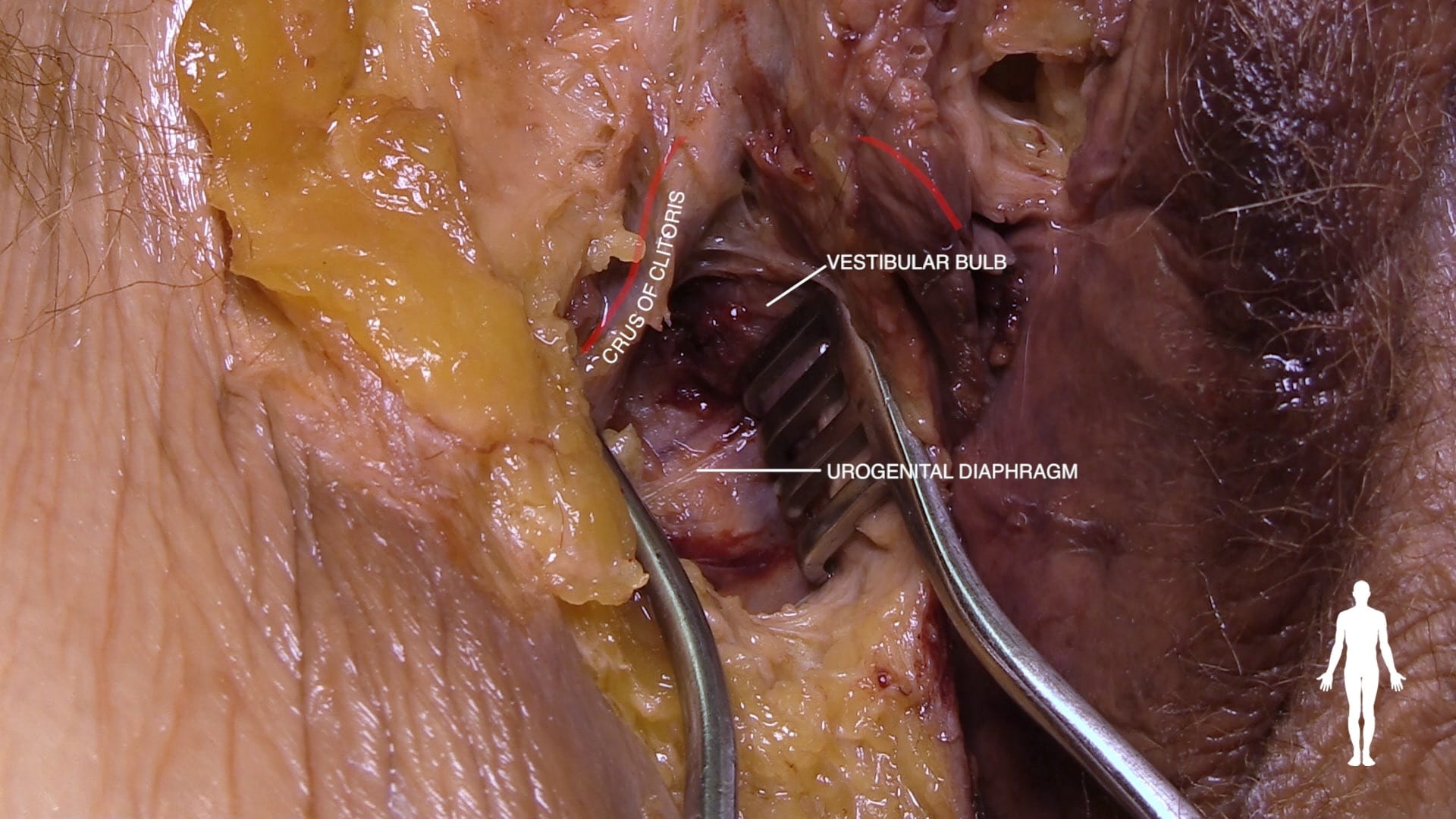 Labels (left to right): Crus of clitoris, vestibular bulb, urogenital diaphragm