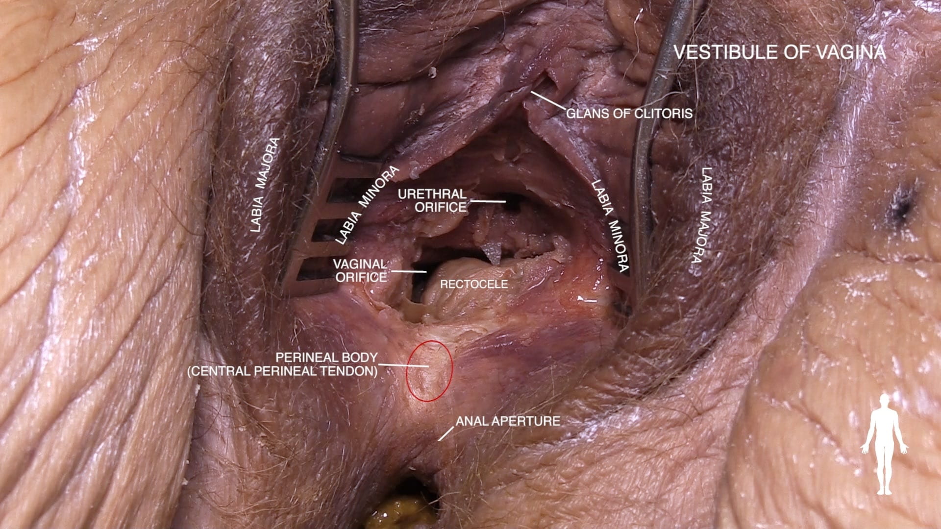 Labels (left to right): Labia majora, perineal body (central perineal tendon), vaginal orifice, labia minora, urethral orifice, rectocele, anal aperture, glans of clitoris, labia minor, labia majora