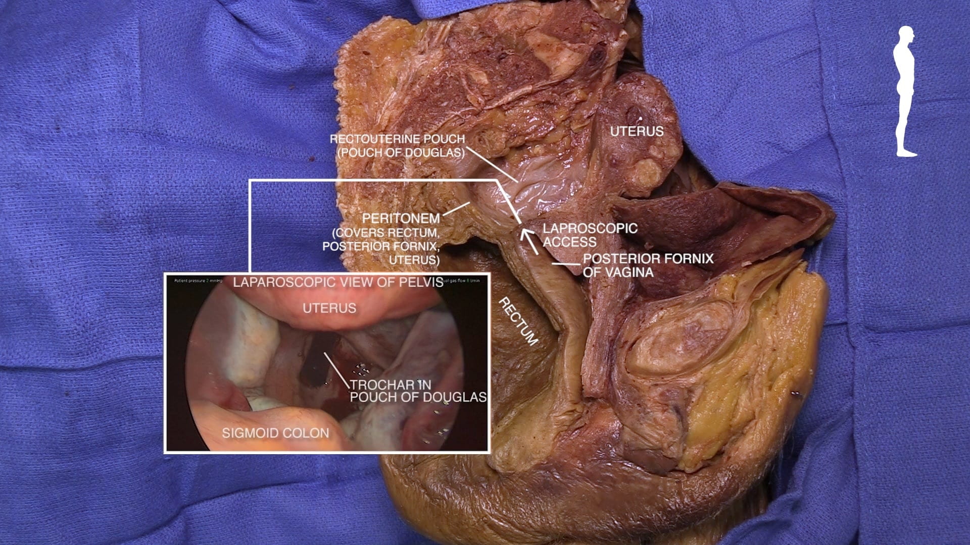 Labels (top to bottom): Uterus, rectouterine pouch (pouch of Douglas), peritoneum (covers rectum, posterior fornix, uterus, laparoscopic access, poster fornix of vagina, rectum Inner image - Laparoscopic view of pelvis: Labels - Uterus, trochar in pouch of Douglas, sigmoid colon