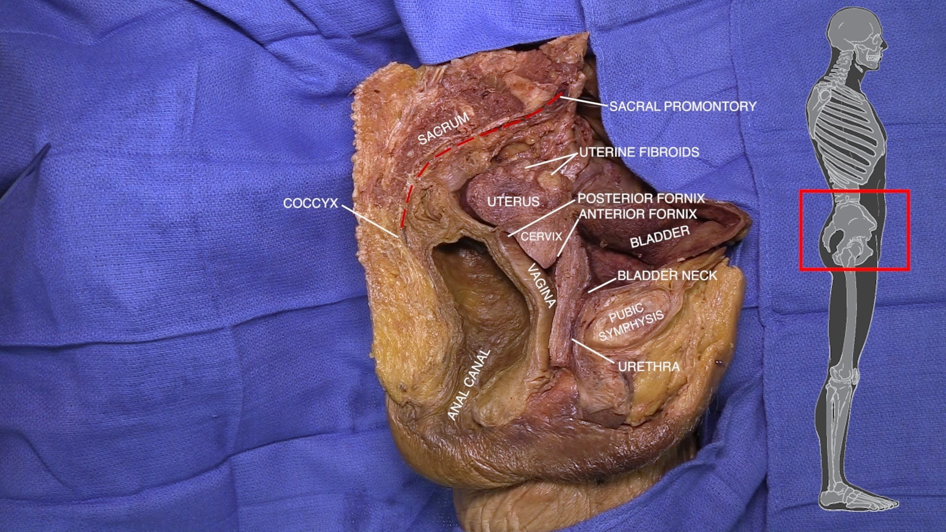 Labels (top to bottom): Sacral promontory, sacrum, uterine fibroids, coccyx, uterus, posterior fornix, anterior fornix, cervix, bladder, vagina, bladder neck, pubic symphysis, urethra, anal canal