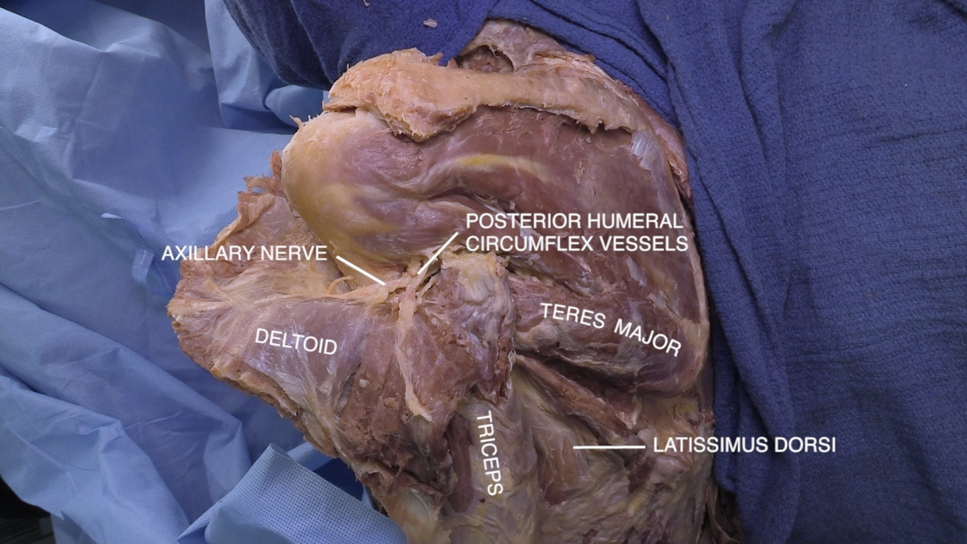 Labels (top to bottom): Posterior humeral circumflex vessels, axillary nerve, teres major, deltoid, triceps, latissimus dorsi