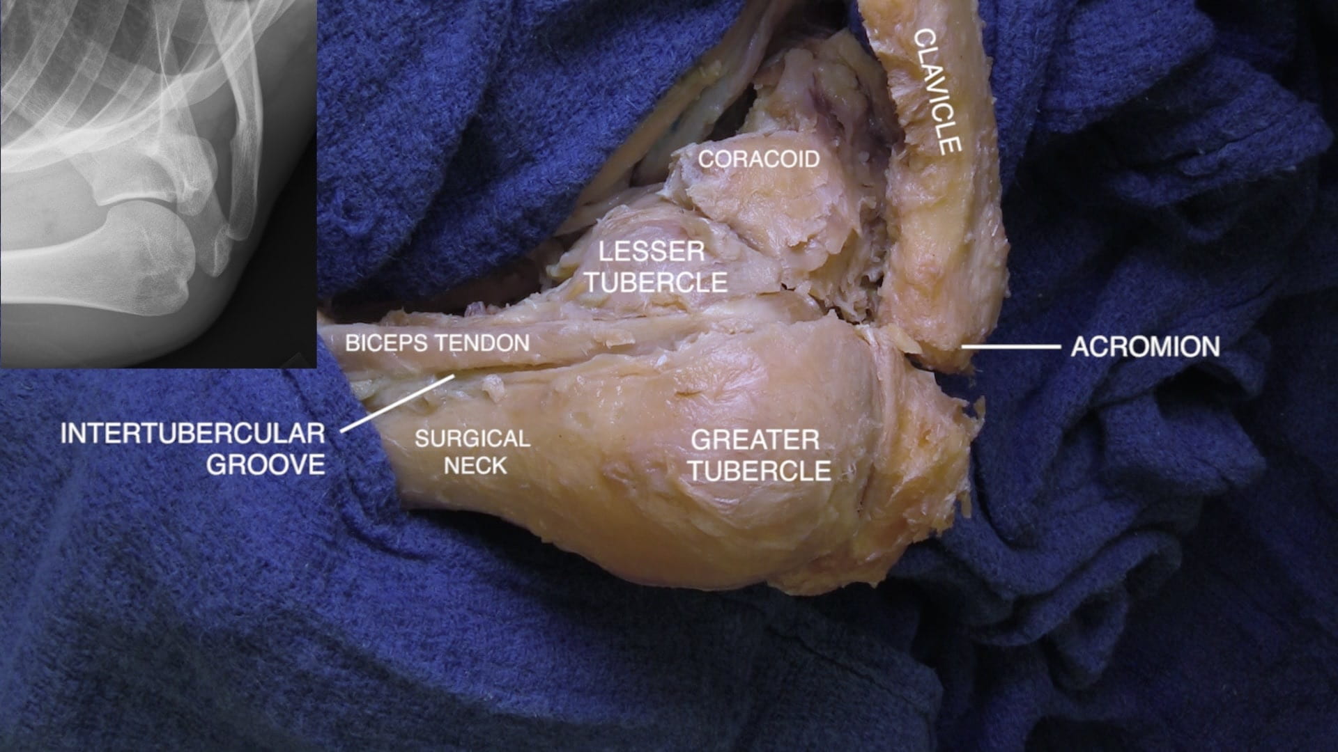 Labels (left to right): Intertubercular groove, biceps tendon, surgical neck, lesser tubercle, greater tubercle, coracoid, clavicle, acromion