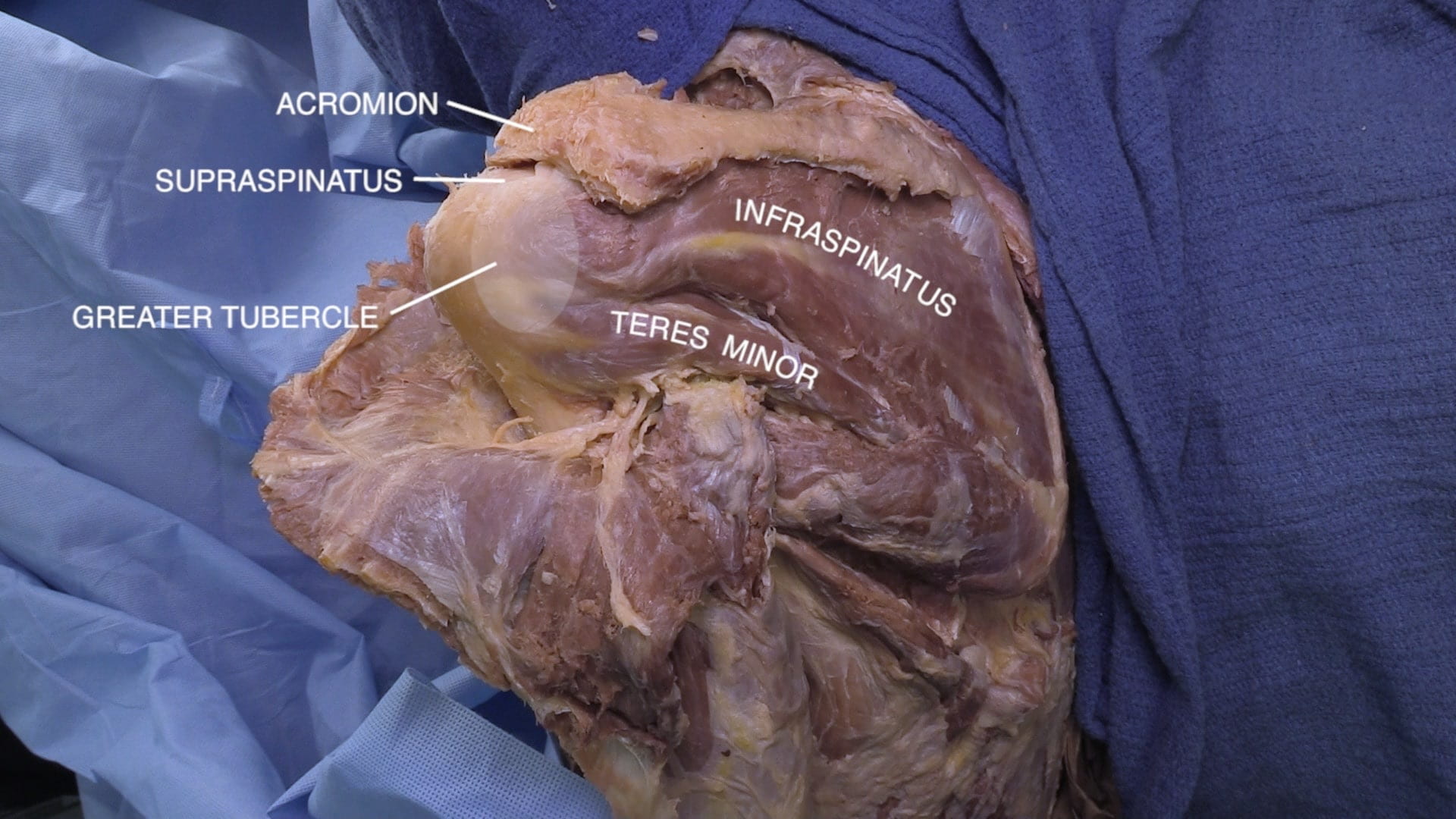 Labels (top to bottom): Acromion, supraspinatus, infraspinatus, greater tubercle, teres minor