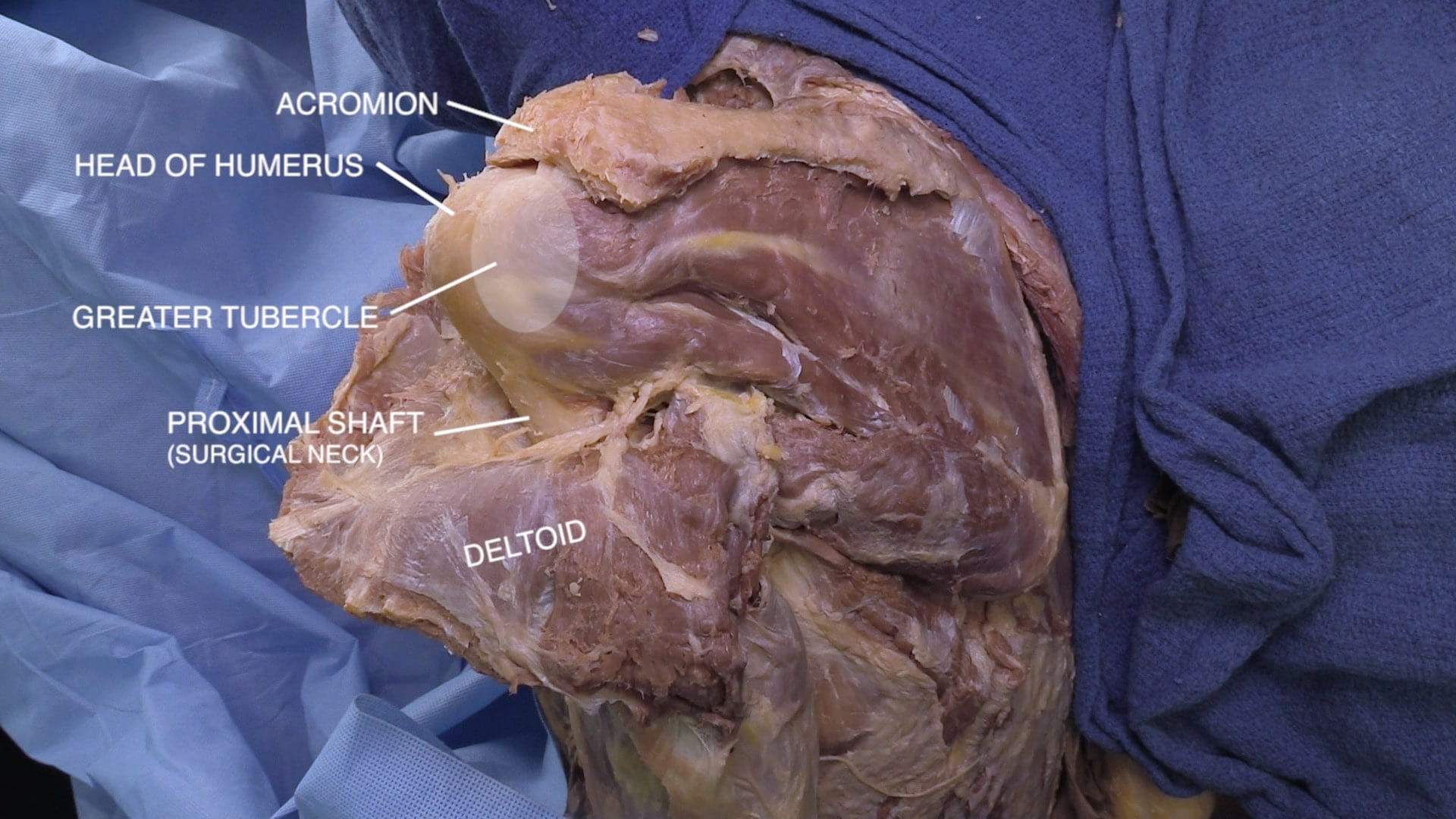 Labels (top to bottom): Acromion, head of humerus, greater tubercle, proximal shaft (surgical neck), deltoid