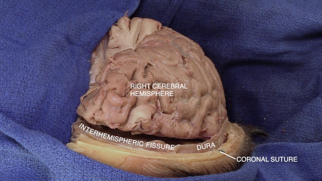 Labels (top to bottom): right cerebral hemisphere, interhemispheric fissure, dura, coronal suture
