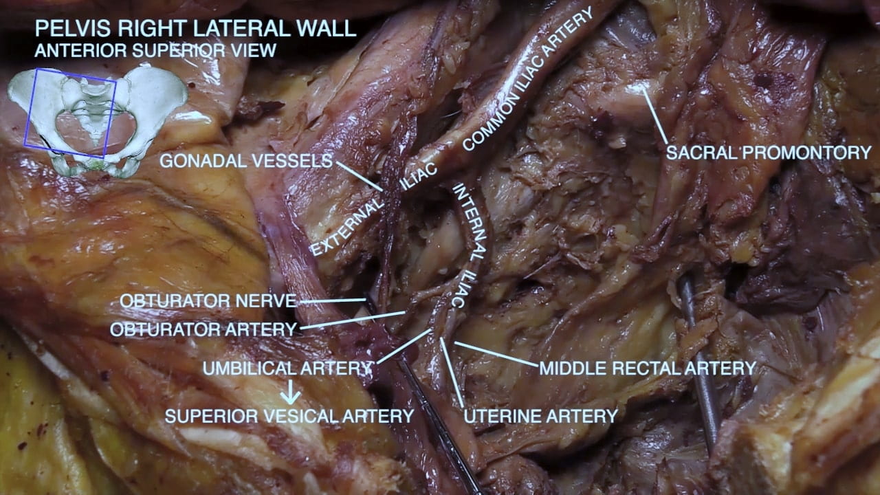 Labels (top to bottom): Common iliac artier, sacral promontory, gonadal vessels, external iliac, internal iliac, obturator nerve, obturator artery, umbilical artery to superior vesicle artery, middle rectal artery, uterine artery