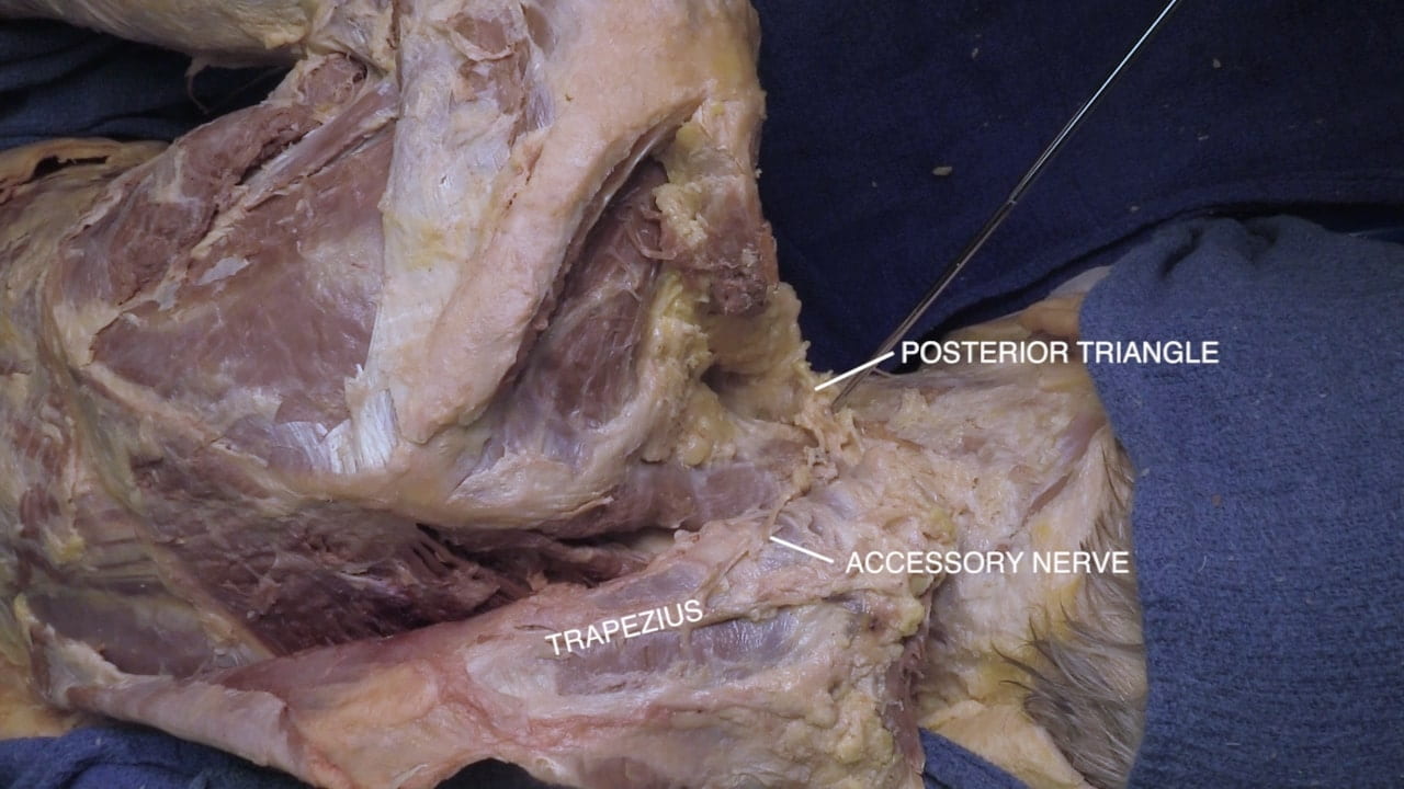 Labels (top to bottom): Posterior triangle, accessory nerve, trapezius