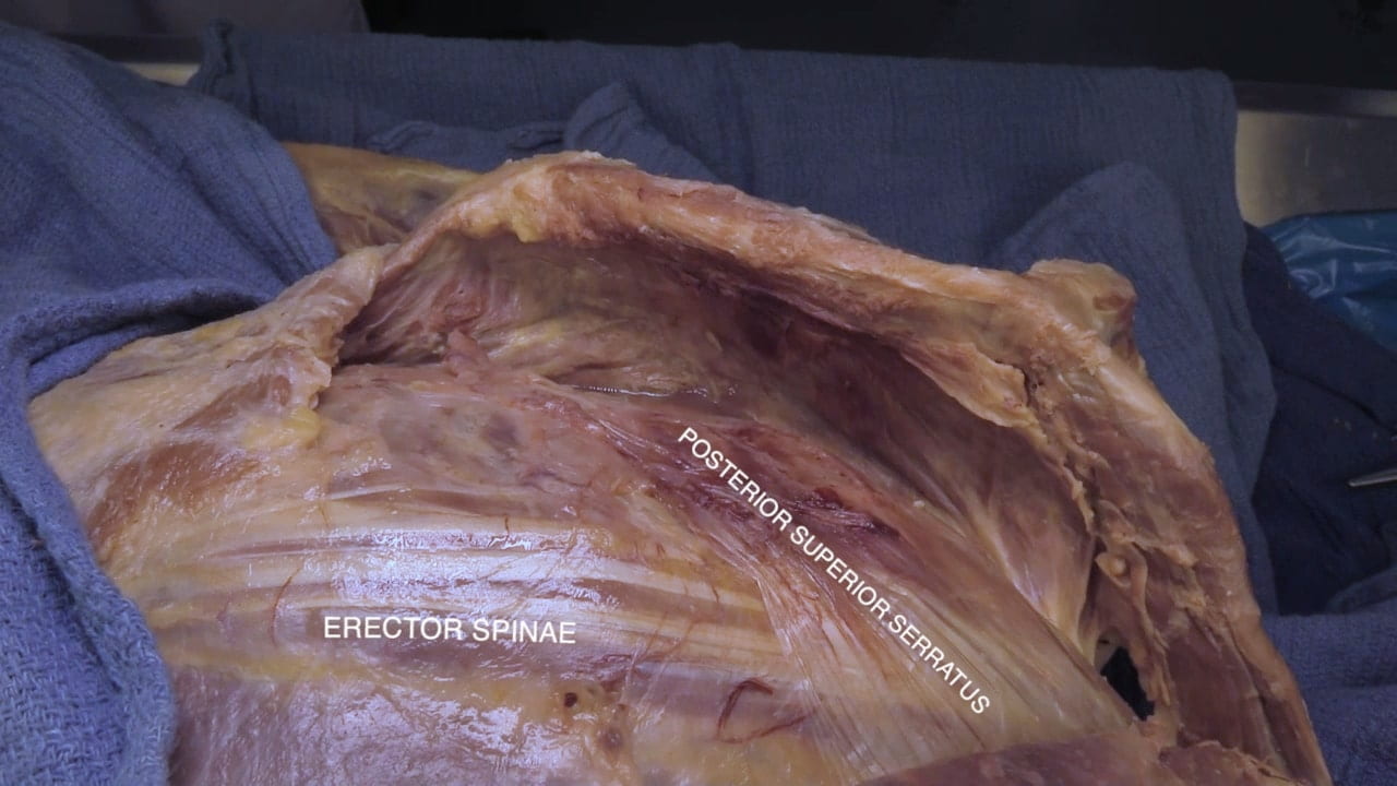 Labels (top to bottom): Posterior superior serratus, erector spinae