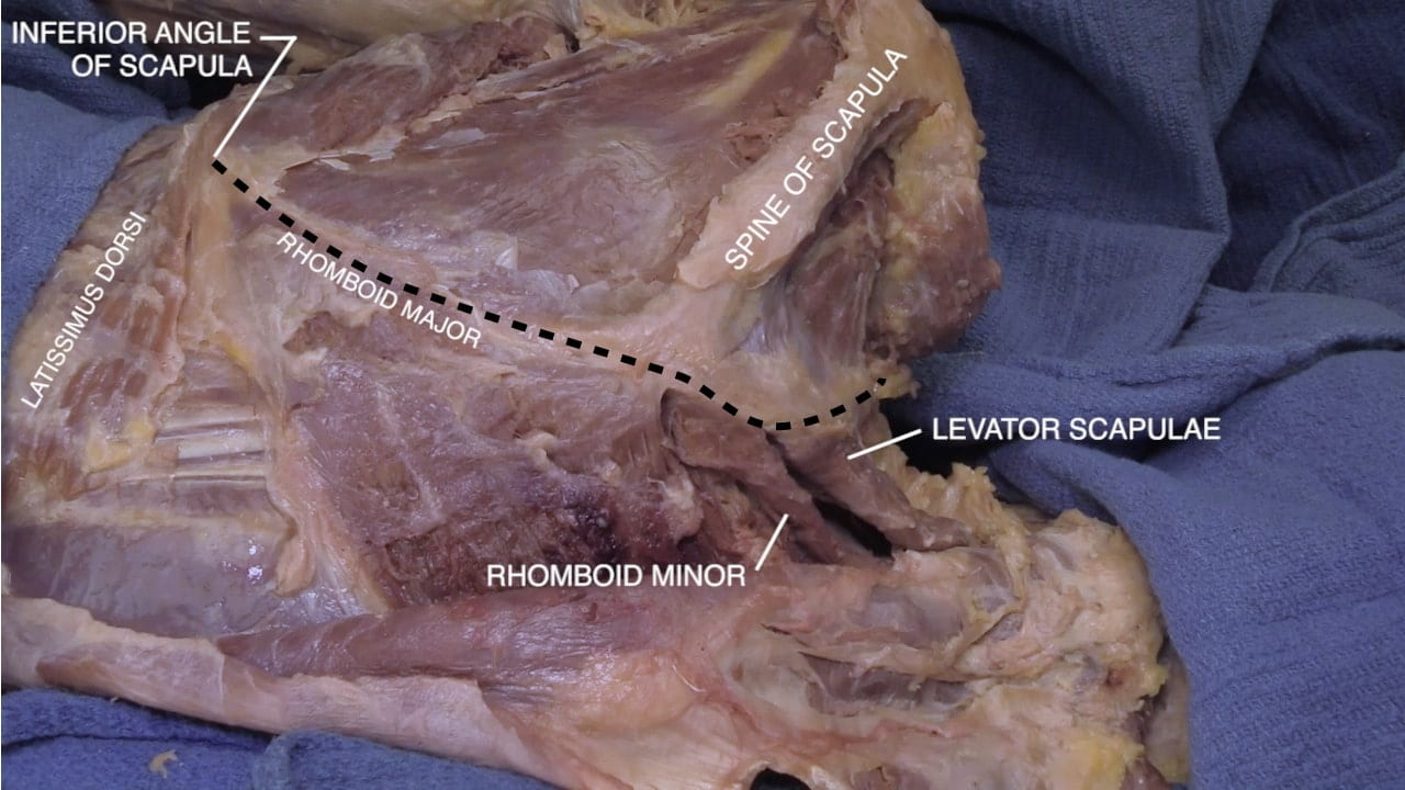 Labels (top to bottom): Inferior angle of scapula, spine of scapula, rhomboid major, latissimus dorsi, levator scapulae, rhomboid minor