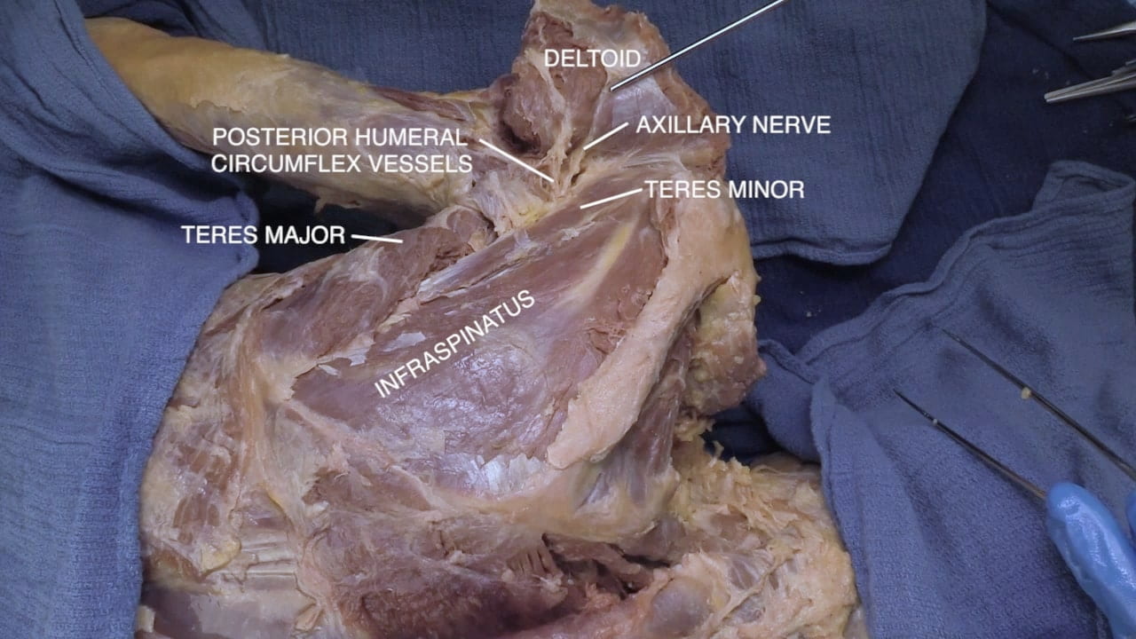 Labels (top to bottom): Deltoid, axillary nerve, posterior humeral circumflex vessels, teres minor, teres major, infraspinatus