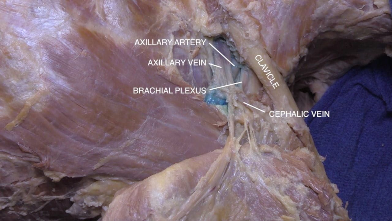 Labels (top to bottom): Axillary artery, axillary vein, clavicle, brachial plexus, cephalic vein