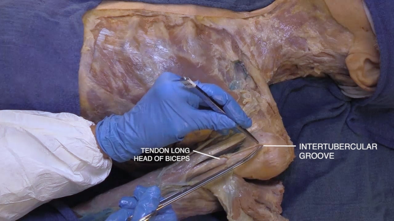 Labels (top to bottom): Intertubercular groove, tendon long head of biceps