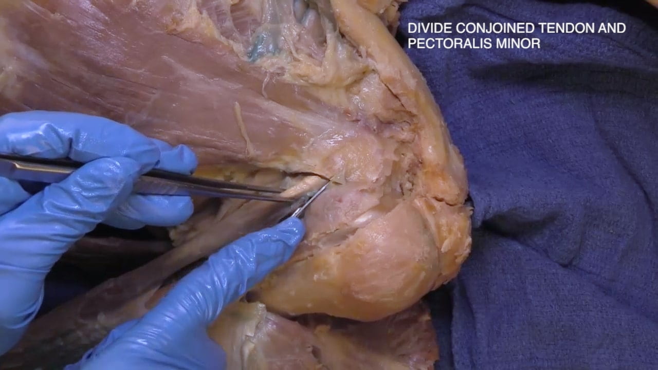 Divide conjoined tendon and pectoralis minor