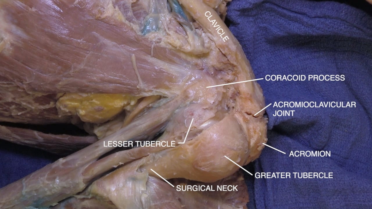 Labels (top to bottom): Clavicle, coracoid process, acromioclavicular joint, lesser tubercle, acromion, greater tubercle, surgical neck