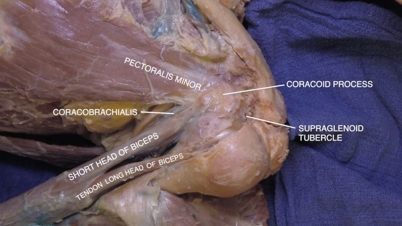 Labels (top to bottom): Pectoralis minor, coracoid process, coracobrachialis, supraglenoid tubercle, short head of biceps, tendon long head of biceps