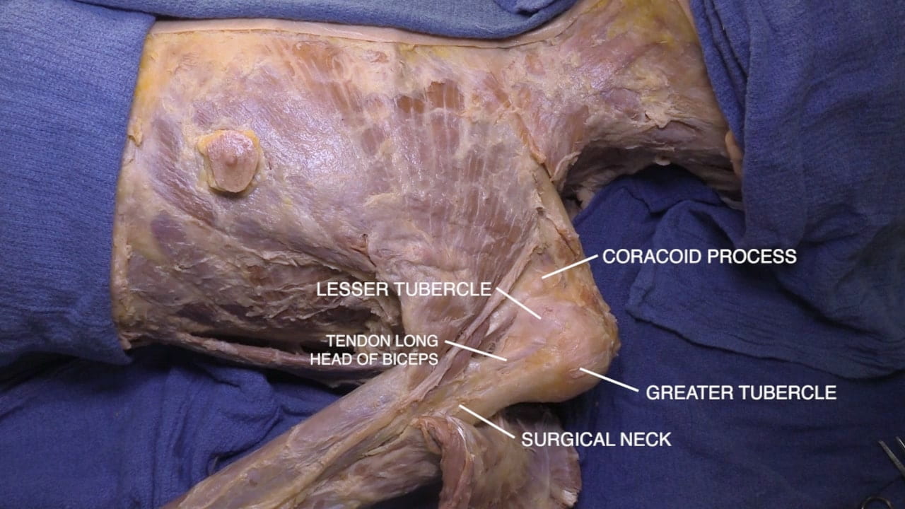 Labels (top to bottom): Coracoid process, lesser tubercle, tendon long head of biceps, greater tubercle, surgical neck