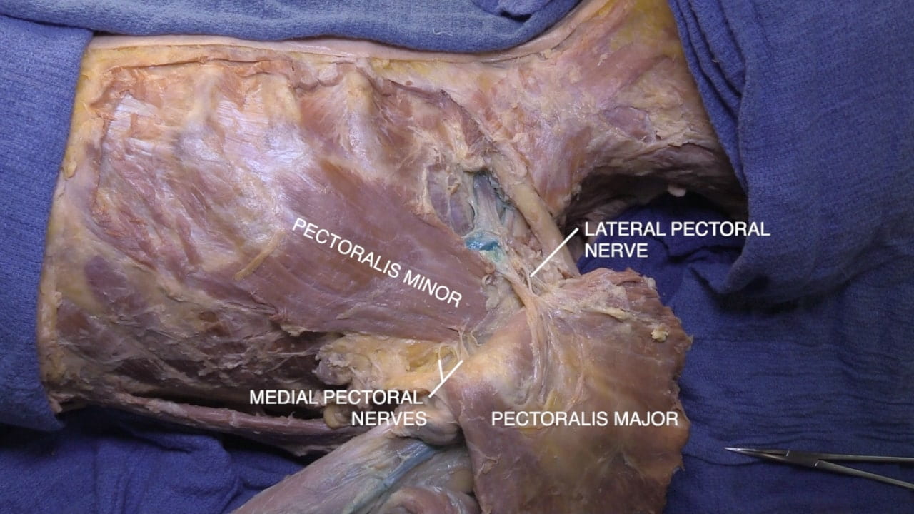 Labels (top to bottom): Lateral pectoral nerve, pectoralis minor, medial pectoral nerves, pectoralis major