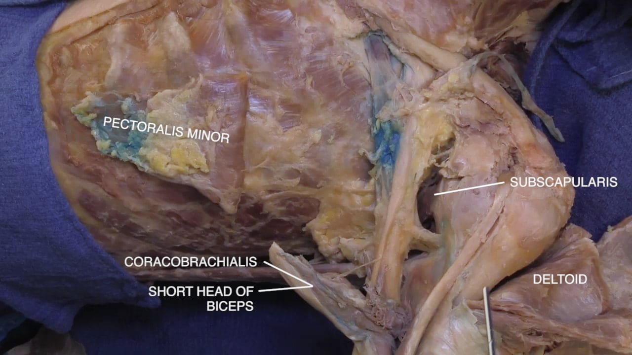 Labels (top to bottom): Pectoralis minor, subscapularis, coracobrachialis, deltoid, short head of biceps