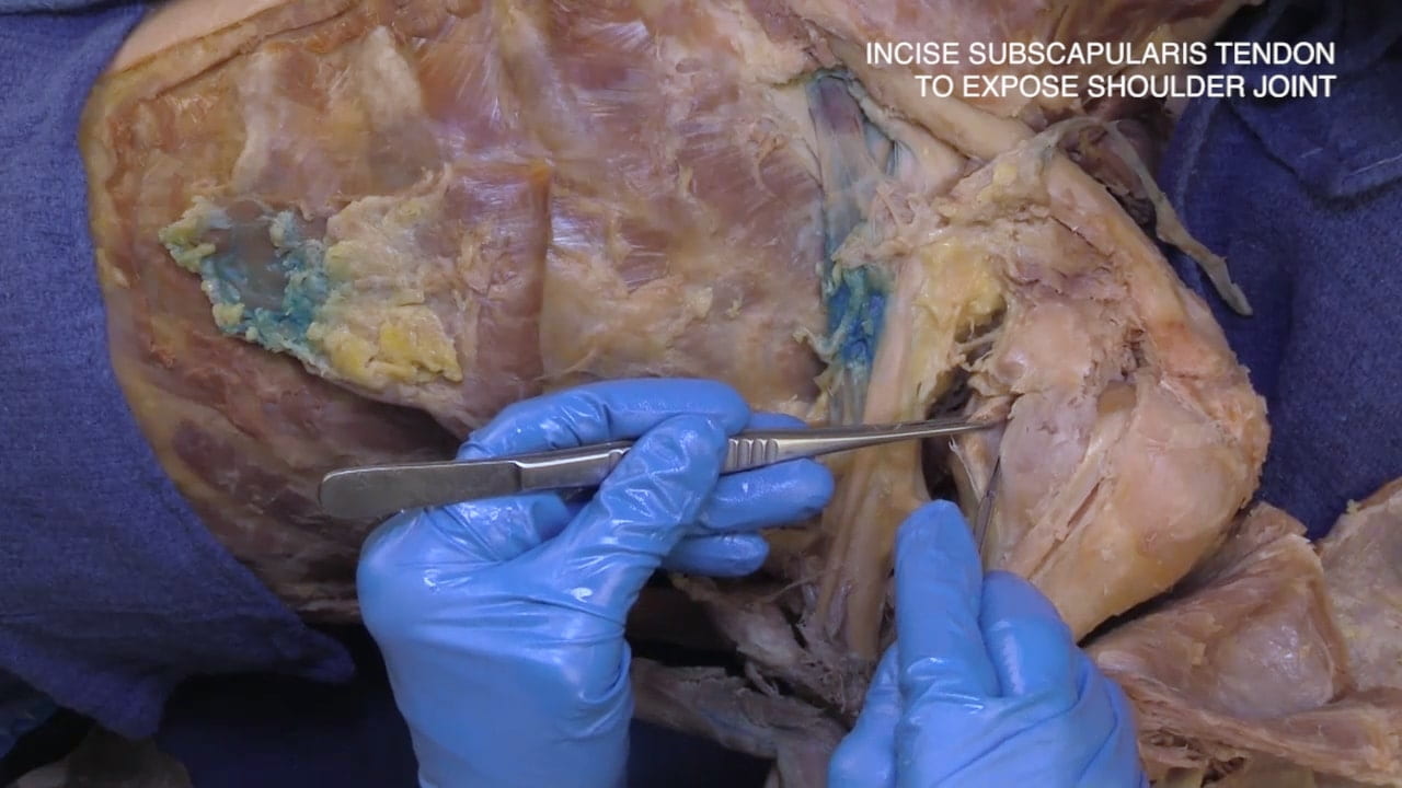 Incise subscapularis tendon to expose shoulder joint