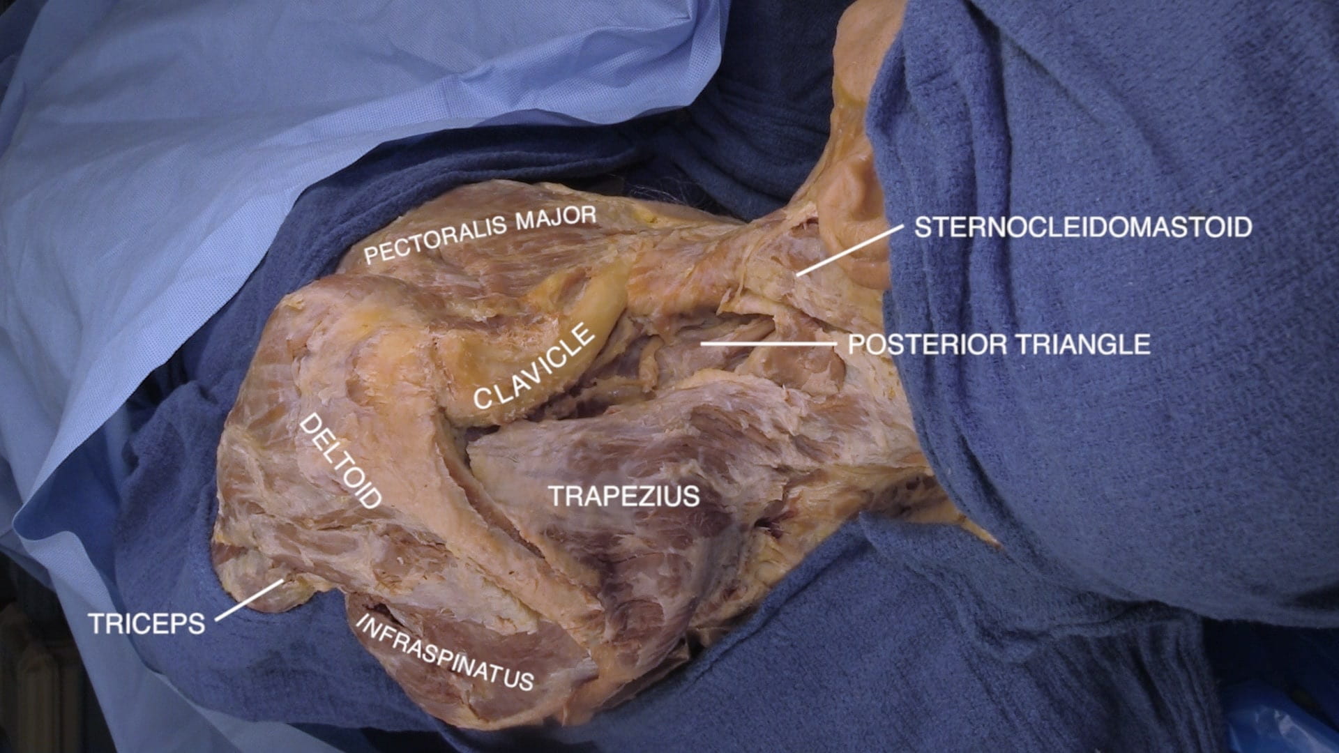 Labels (top to bottom): Pectoralis major, sternocleidomastoid, posterior triangle, clavicle, deltoid, trapezius, triceps, infraspinatus