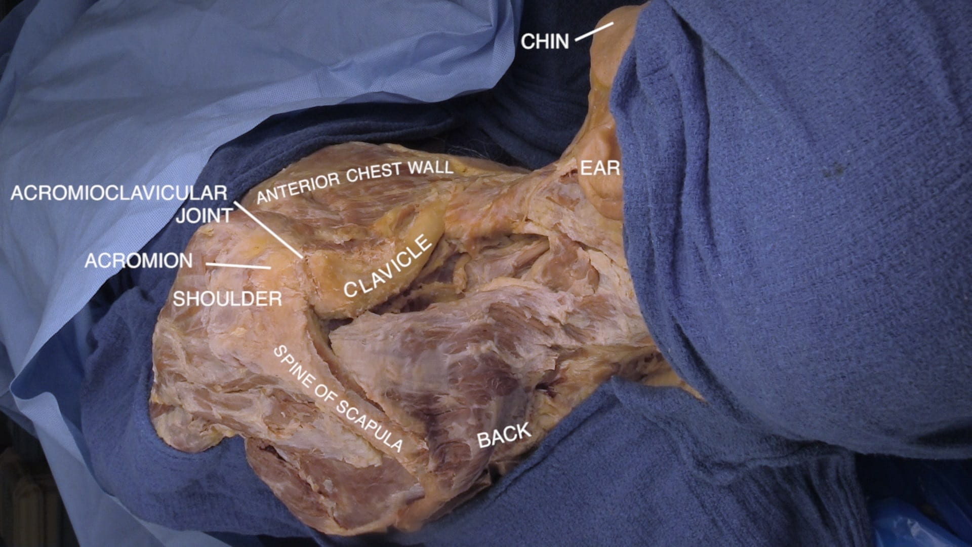 Labels (top to bottom): Chin, ear, acromioclavicular joint, anterior chest wall, acromion, shoulder, clavicle, spine of scapula, back