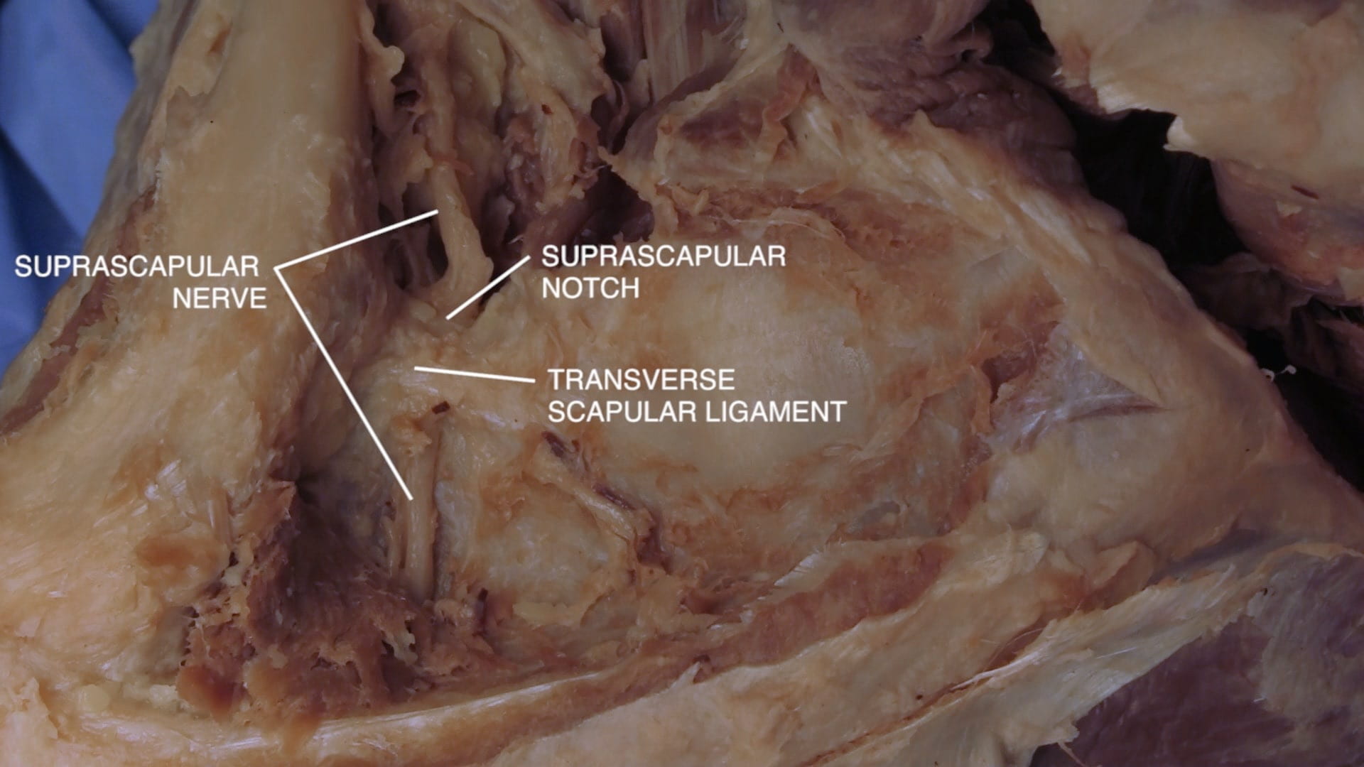 Labels (top to bottom): Suprascapular nerve, suprascapular notch, transverse scapular ligament