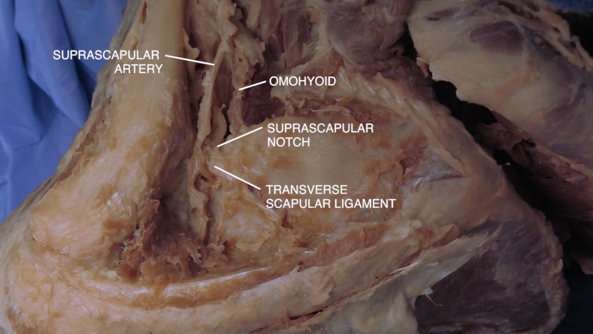 Labels (top to bottom): Suprascapular artery, omohyoid, suprascapular notch, transverse scapular ligament