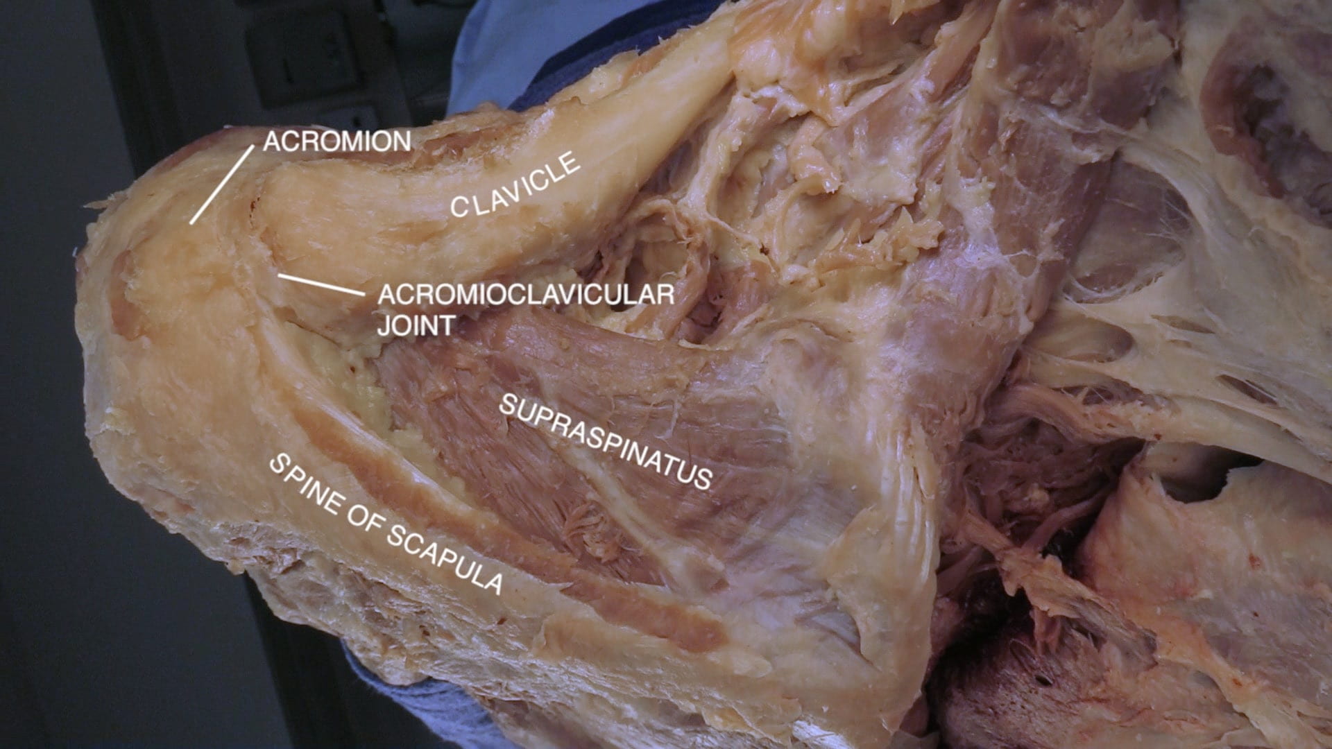 Labels (top to bottom): Acromion, clavicle, acromioclavicular joint, supraspinatus, spine of scapula