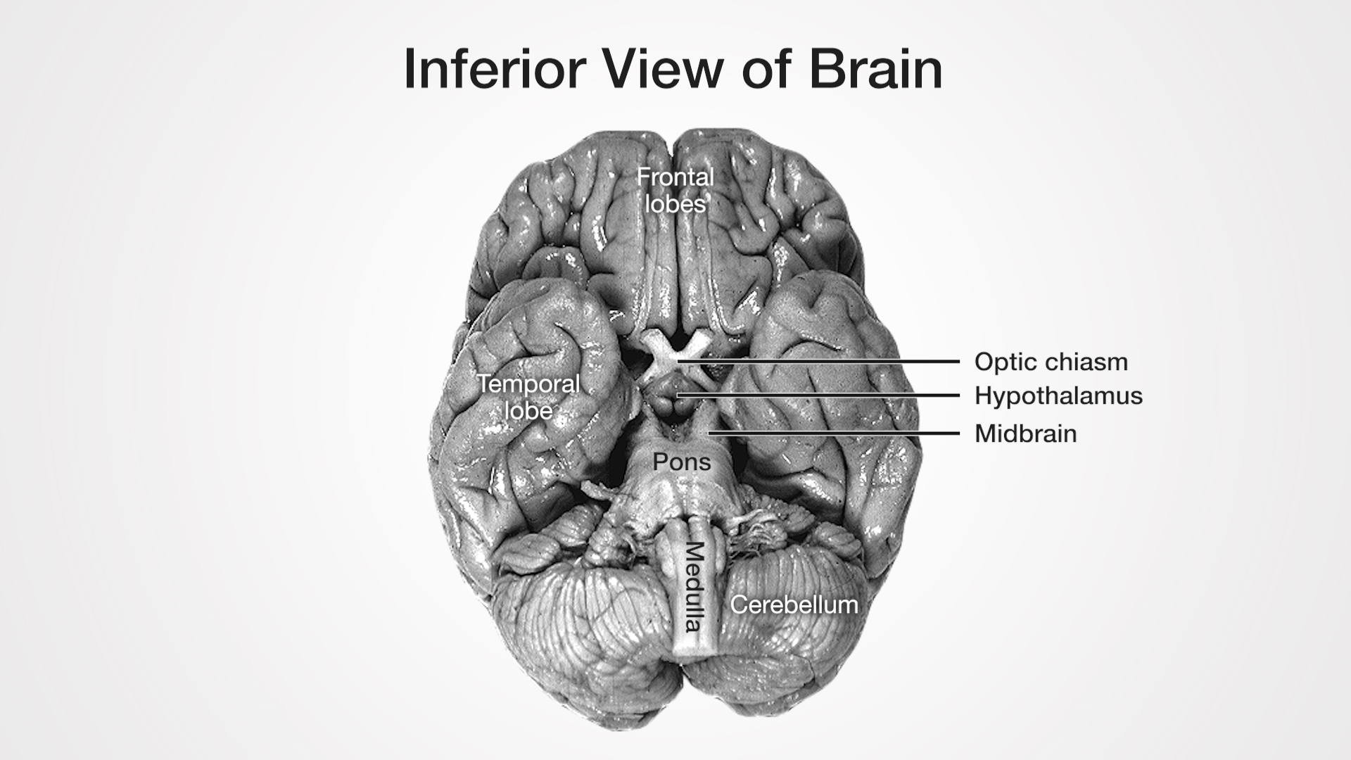 Labels (top to bottom): Frontal lobes, Optic chiasm, Hypothalamus, Midbrain, Temporal lobe, Pons, Medulla, Cerebellum