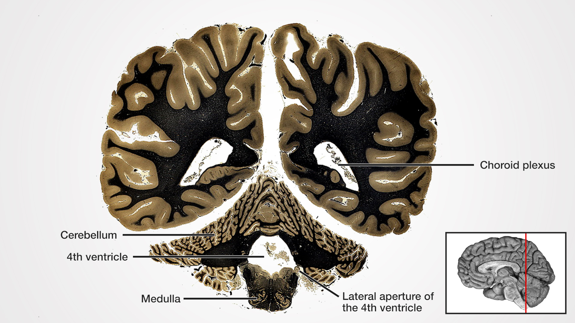 Labels (left to right): Cerebellum, 4th ventricle, medulla, lateral aperture of the 4th ventricle, choroid plexus