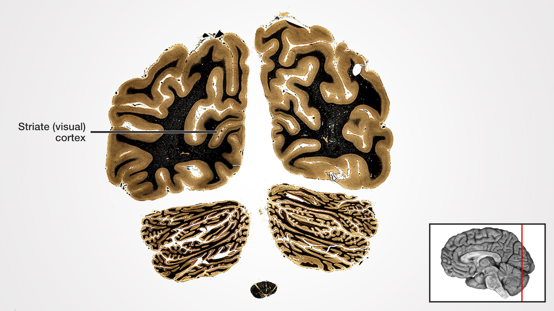 Label: Striate (visual) cortex