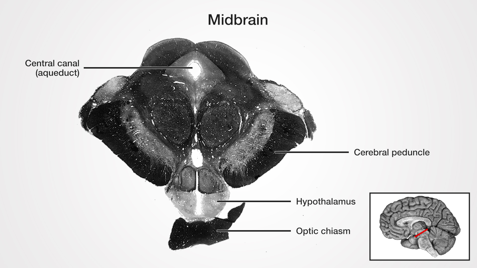 Labels (top to bottom): Central canal (aqueduct), cerebral peduncle, hypothalamus, optic chiasm