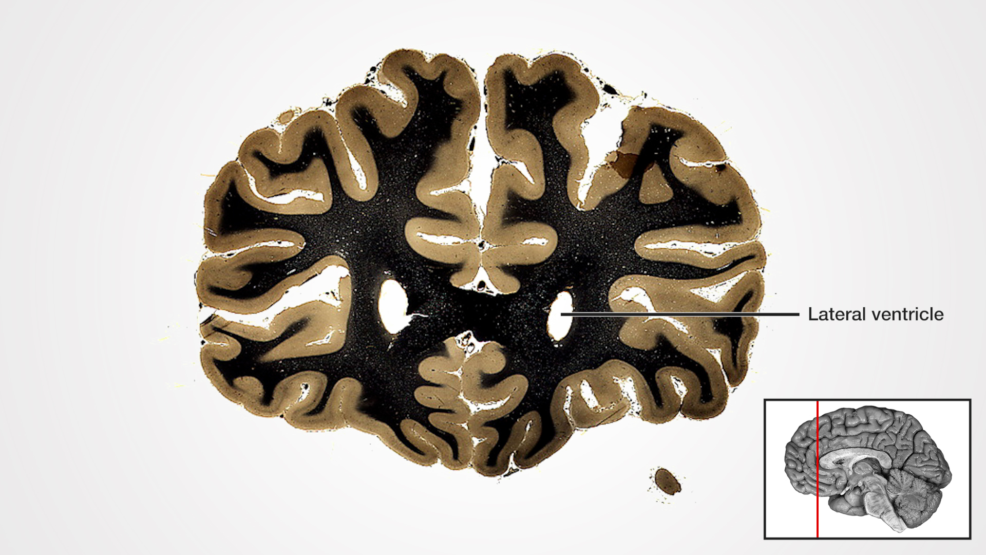 Label: Lateral ventricle