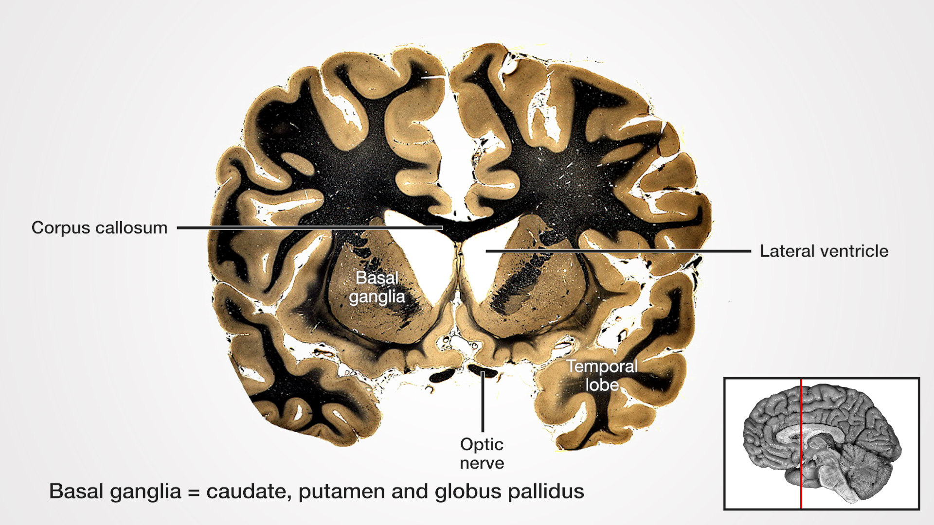 Text: Basal ganglia = caudate, putamen and globus pallidus Labels (Left to right): Corpus callous, basal ganglia, optic nerve, temporal lobe, lateral ventricle