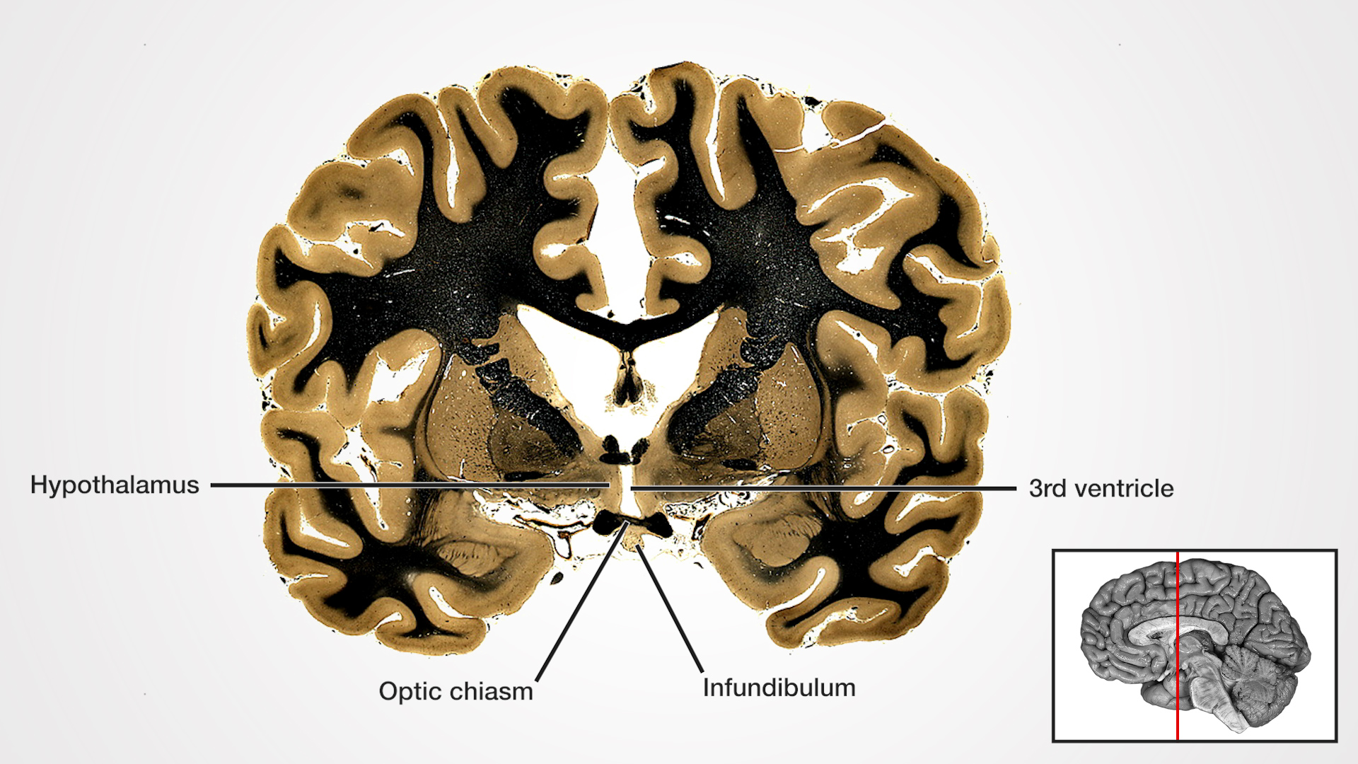 Labels (left to right): Hypothalamus, optic chiasm, infundibulum, 3rd ventricle