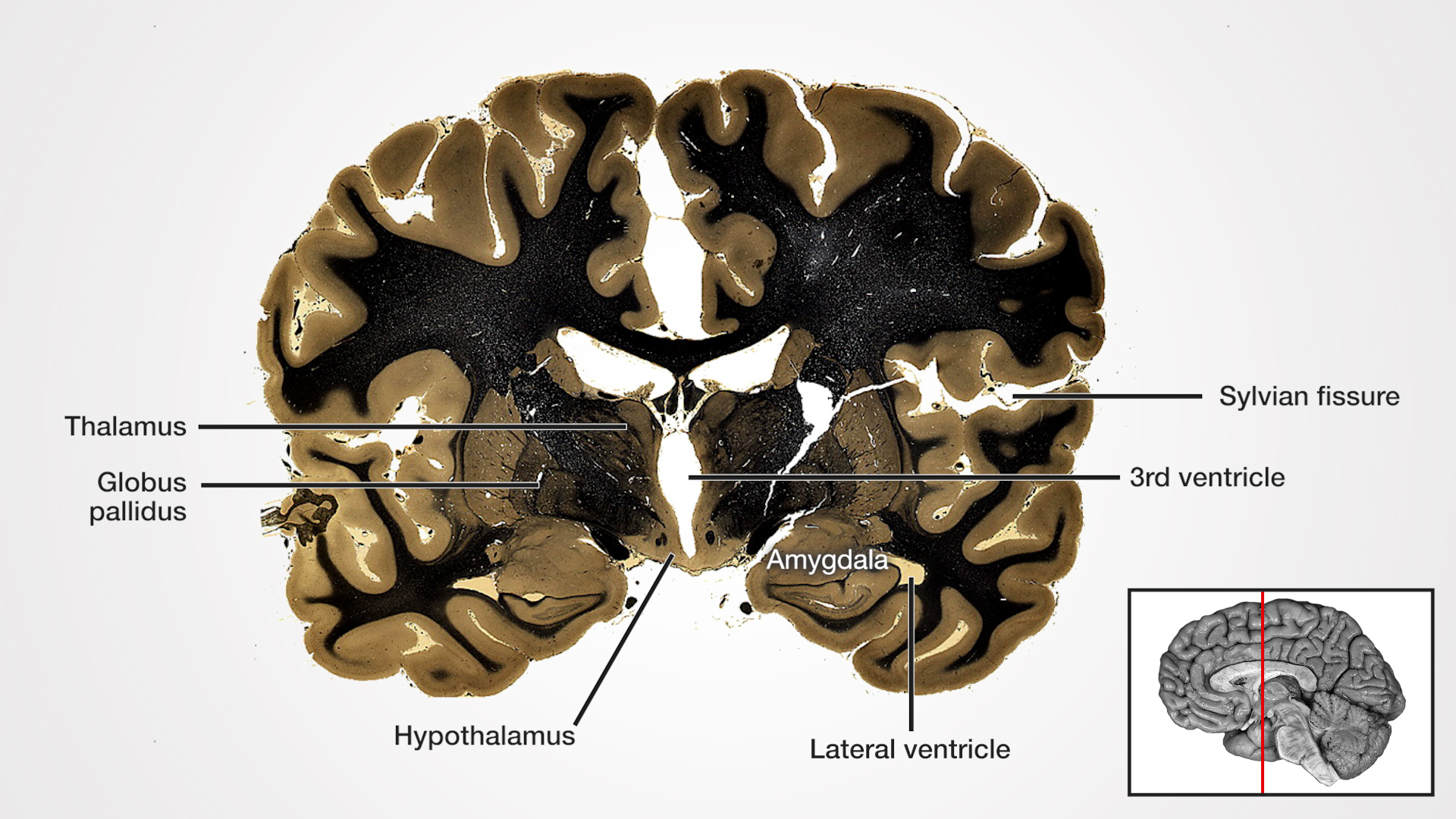 Labels (Left to right): Thalamus, globus pallidus, hypothalamus, amygdala, lateral ventricle, 3rd ventricle, Sylvian fissure